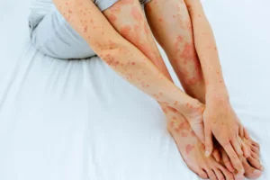 Psoríase: não se pega, mas o estresse pode desencadear