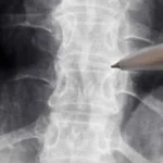 Anvisa libera estudo com medicamento para lesões na medula espinhal