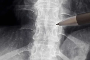 Anvisa libera estudo com medicamento para lesões na medula espinhal