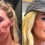 Influenciadora diz ter procurado 21 médicos após 'derretimento facial'