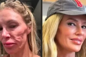 Influenciadora diz ter procurado 21 médicos após 'derretimento facial'