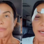 Ivete Sangalo deixa hospital com olho roxo e tranquiliza fãs