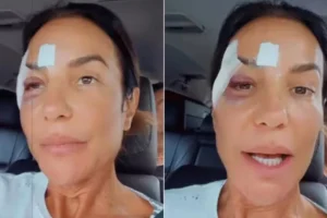 Ivete Sangalo deixa hospital com olho roxo e tranquiliza fãs