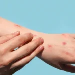 Mpox: veja como identificar sintomas e prevenir a transmissão doméstica