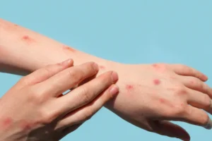 Mpox: veja como identificar sintomas e prevenir a transmissão doméstica