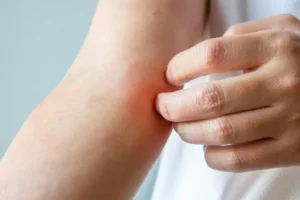 Surto de fungo sexual “altamente contagioso” preocupa Europa