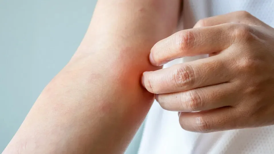 Surto de fungo sexual “altamente contagioso” preocupa Europa