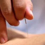 6 principais benefícios da Acupuntura, segundo especialistas