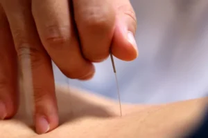 6 principais benefícios da Acupuntura, segundo especialistas