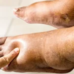 Corpo inchado? Pode ser mais sério do que parece!