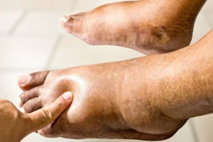 Corpo inchado? Pode ser mais sério do que parece!