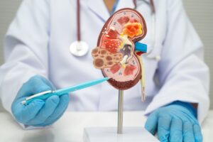 Doença renal pode avançar em silêncio e só dar sinais quando parte da função foi perdida