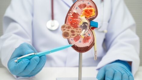 Doença renal pode avançar em silêncio e só dar sinais quando parte da função foi perdida