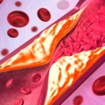 Hábito no café da manhã pode elevar risco de doenças cardíacas; entenda