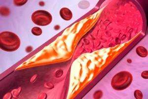 Hábito no café da manhã pode elevar risco de doenças cardíacas; entenda