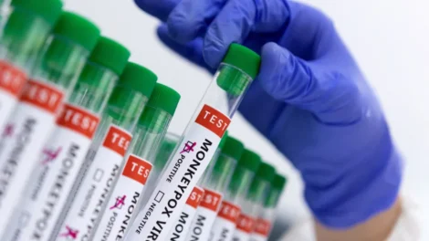 Mpox aumenta no Brasil e reacende alerta para monitoramento e vigilância