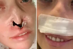 Mulher faz implante dentário e fica com ‘buraco’ no rosto: “Dói muito"