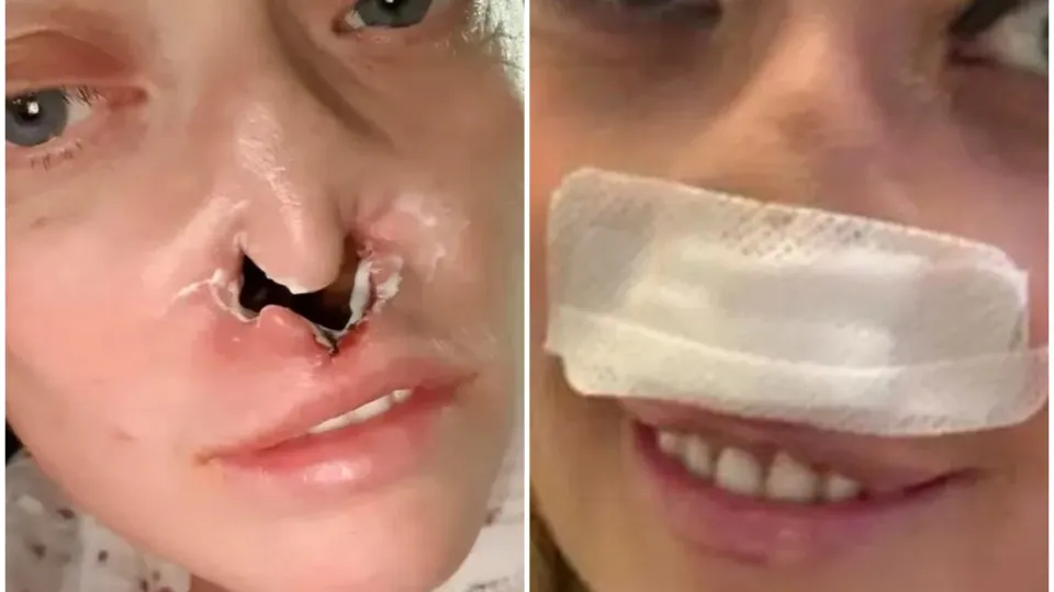 Mulher faz implante dentário e fica com ‘buraco’ no rosto: “Dói muito"