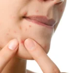 Os 3 piores alimentos para a pele: Os primeiros efeitos aparecem no rosto