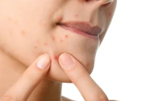 Os 3 piores alimentos para a pele: Os primeiros efeitos aparecem no rosto