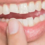Quebrou o dente? O que fazer nos primeiros minutos para salvar o sorriso?