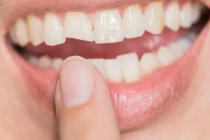 Quebrou o dente? O que fazer nos primeiros minutos para salvar o sorriso?