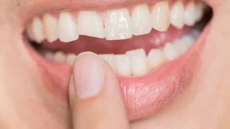 Quebrou o dente? O que fazer nos primeiros minutos para salvar o sorriso?