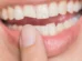 Quebrou o dente? O que fazer nos primeiros minutos para salvar o sorriso?