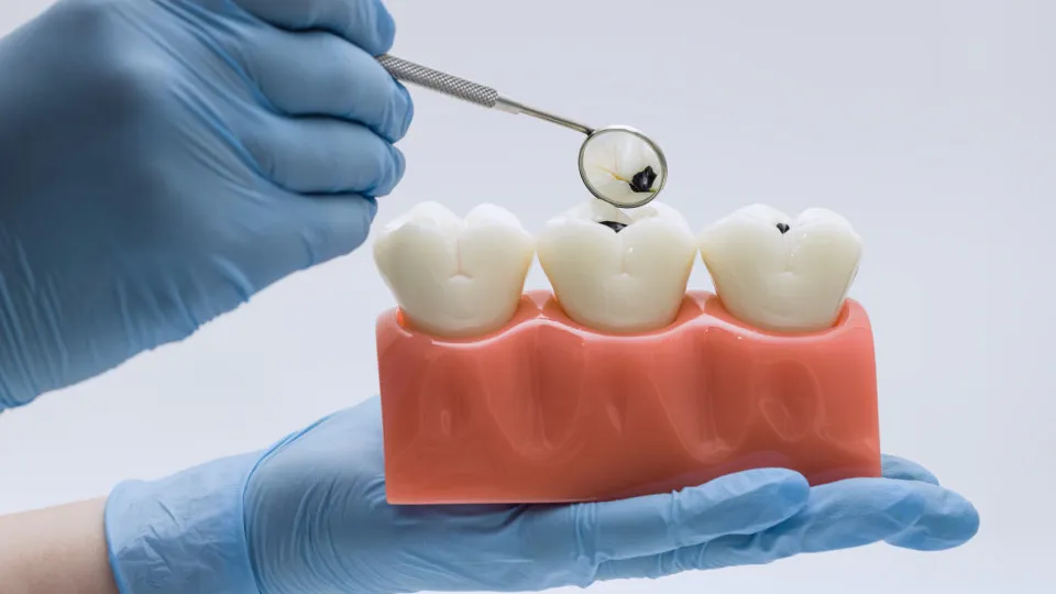 Alimentos “inofensivos” podem destruir o esmalte dos dentes; veja