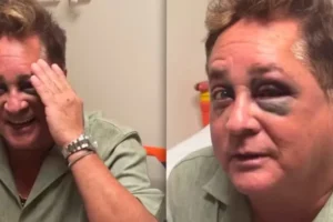 Leonardo sofre acidente em pescaria e aparece com olho roxo