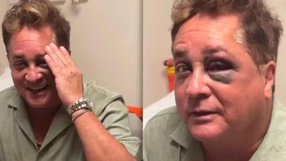 Leonardo sofre acidente em pescaria e aparece com olho roxo