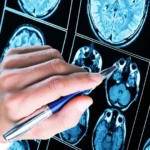 Mais de 50% dos diagnósticos de autismo ocorrem antes dos 5 anos de idade