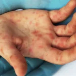 Ministério da Saúde confirma caso de sarampo no Rio de Janeiro