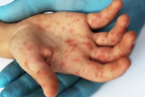 Ministério da Saúde confirma caso de sarampo no Rio de Janeiro