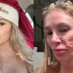 Ex-modelo que teve rosto 'derretido' revela origem da doença