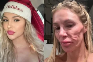 Ex-modelo que teve rosto 'derretido' revela origem da doença