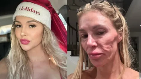 Ex-modelo que teve rosto 'derretido' revela origem da doença