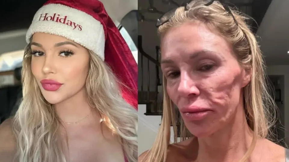 Ex-modelo que teve rosto 'derretido' revela origem da doença