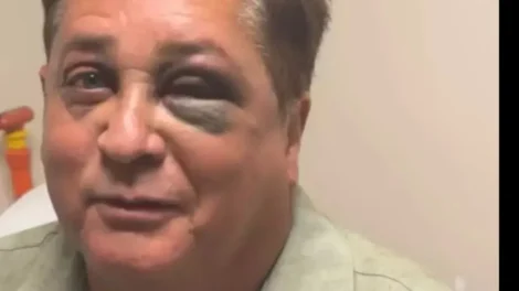 Leonardo revela fratura no rosto após queda em pescaria