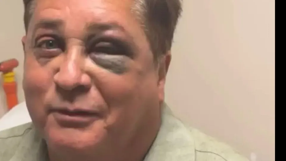Leonardo revela fratura no rosto após queda em pescaria