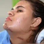 'Me fiz de morta', diz estudante que teve as mãos amputadas em ataque com foice no Ceará