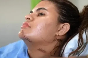 'Me fiz de morta', diz estudante que teve as mãos amputadas em ataque com foice no Ceará