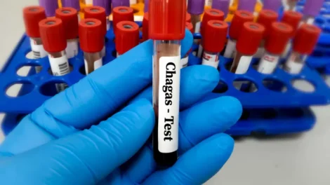 Risco cardíaco dobra para pacientes com doença de Chagas após cirurgia