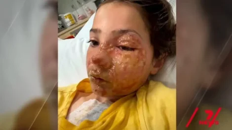 Menina de 10 anos sofre queimaduras no rosto após fazer desafio do TikTok
