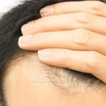 Cabelo transplantado pode cair? Veja alguns detalhes sobre o procedimento