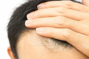 Cabelo transplantado pode cair? Veja alguns detalhes sobre o procedimento
