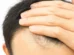 Cabelo transplantado pode cair? Veja alguns detalhes sobre o procedimento