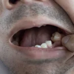 Coisas que fazem seu dente cair