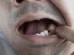 Coisas que fazem seu dente cair