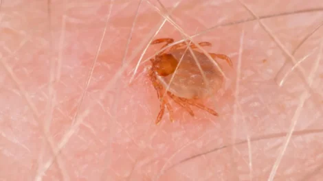 Febre maculosa mata 17 pessoas em São Paulo em 2026